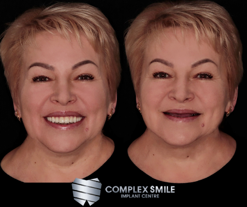 Complex Smile Implant Centre