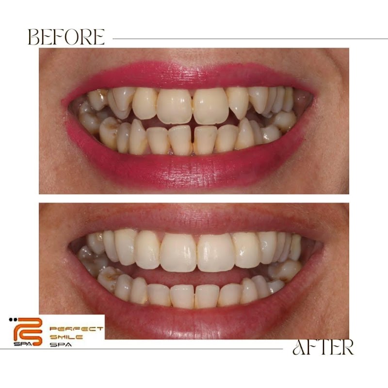 Perfect Smile Spa - Dental Veneers, implants, Bonding & invisalign Braces Essex