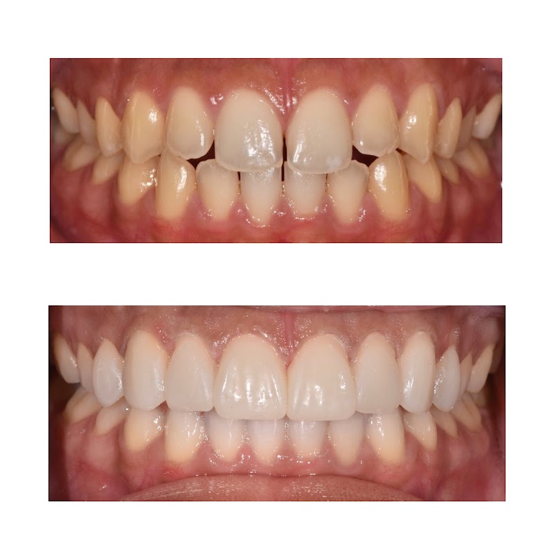 Watford Smiles Invisalign, Composite Bonding, Veneers & Dental Implants