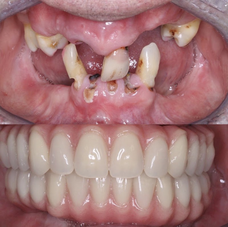 Dr Adeel Ali | Implantology and Full Jaw Teeth In A Day