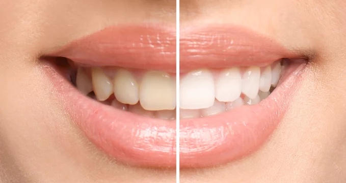 Kelsey Park Dental - Cosmetic & Implants