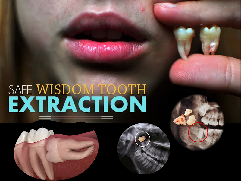 Wisdom Tooth Extraction & Simple Extraction